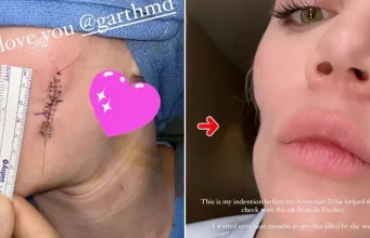 Khloe Kardashian Shares Insights on Melanoma Tumor Removal: Learn About this Form of Cancer